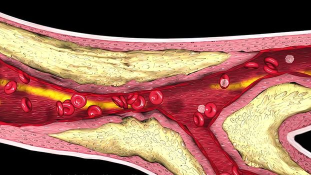 Coronary atherosclerosis, light micrograph showing cholesterol-containing plaque in heart coronary artery, photo under microscope 3D Illustration