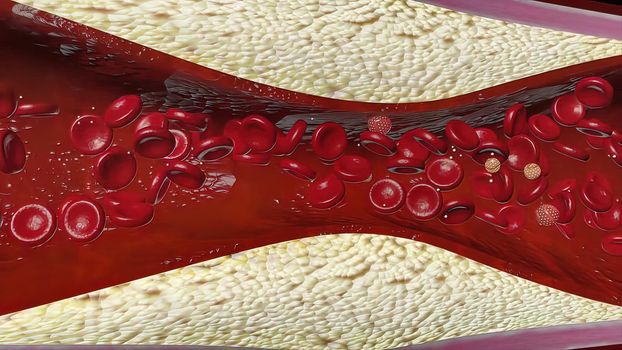 Atherosclerosis with cholesterol blood or plaque in vessel cause of coronary artery disease 3D illustration