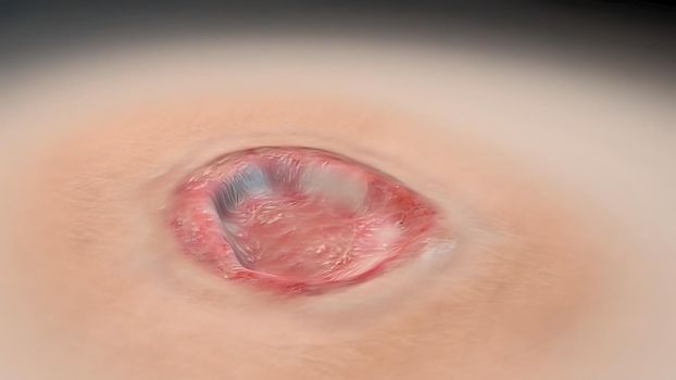 Crust and dressing following a burn or cauterization of the skin 3D illustration