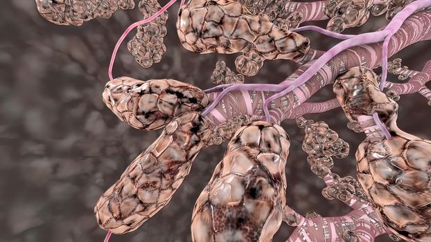 In people with emphysema, the air sacs in the lungs are damaged. 3D illustration