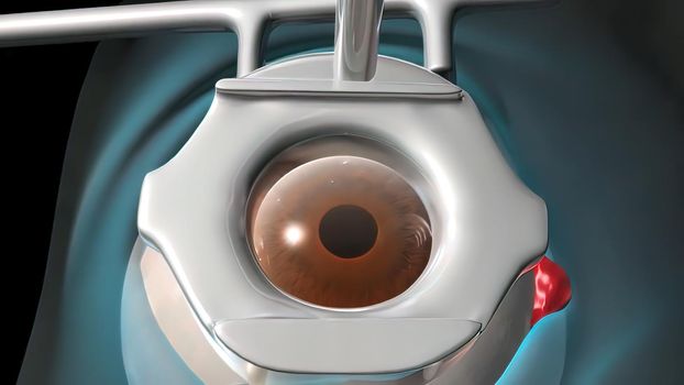 Cataract surgery application view Surgical operations on the human eye 3D illustration