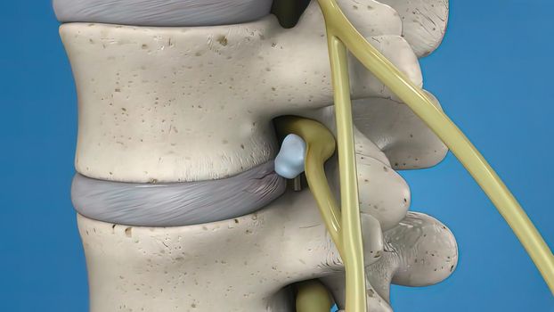 3D illustration of the spinal cord on blue background. Endoscopic lumbar discectomy .