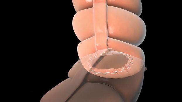 surgery to remove any part of the intestines, bowel resection 3D illustration