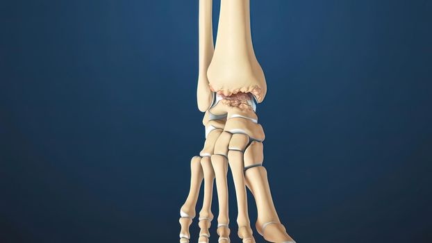 3D Render of Ankle Joint Anatomy and Osteoarthritis.The ankle is where the long tibia and fibula bones of the shin meet with the foot s talus bone.