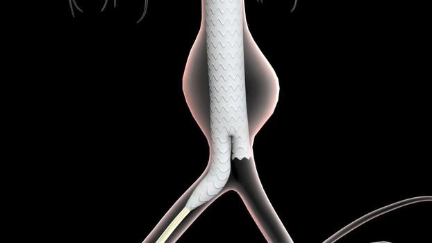 An abdominal aortic aneurysm occurs when a lower portion of the body's main artery (aorta) becomes weakened and bulges