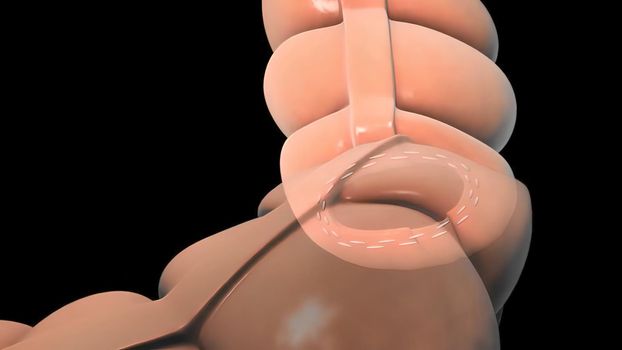 surgery to remove any part of the intestines, bowel resection 3D illustration