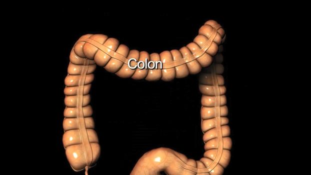 Colon during a enteroscopy with a intestinal or bowel cancer tumor visible. 3D illustration