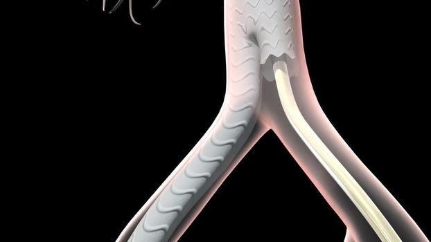 An abdominal aortic aneurysm occurs when a lower portion of the body's main artery (aorta) becomes weakened and bulges