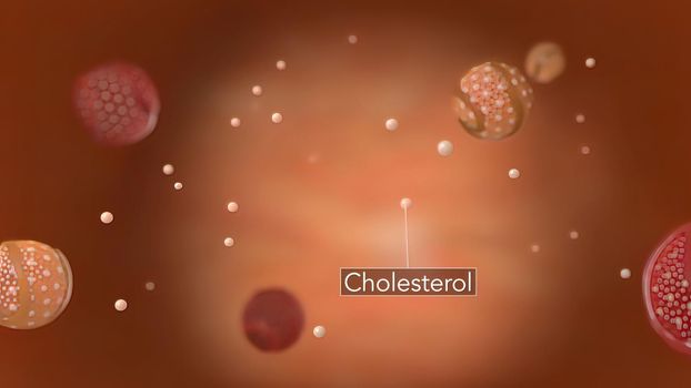 Atherosclerosis, Cholesterol And Other Substances In And On The Artery Walls. 3D illustration