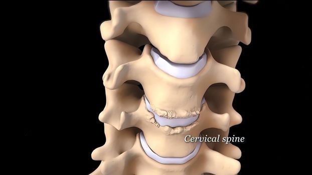 Cervical discs are the cushions or shock absorbers between the bones (vertebra) of the neck (cervical spine) 3D illustration