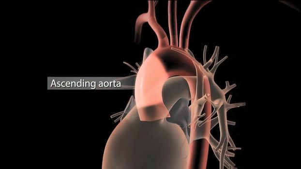 Hypoplastic left heart syndrome is a rare congenital heart defect in which the left side of the heart is severely underdeveloped.It may affect the left ventricle, aorta, aortic valve, or mitral valve. 3D Render