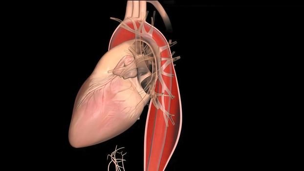 Hypoplastic left heart syndrome is a rare congenital heart defect in which the left side of the heart is severely underdeveloped.It may affect the left ventricle, aorta, aortic valve, or mitral valve. 3D Render