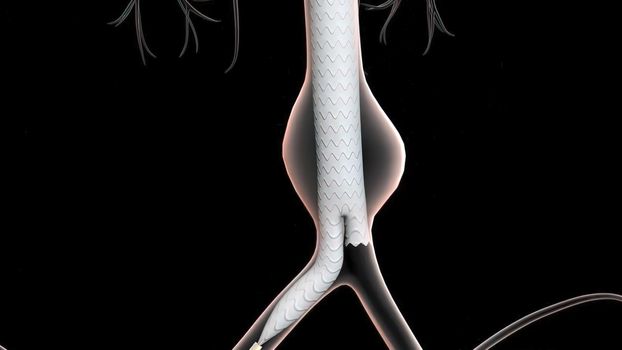 3D medical illustration of pulsatile Abdominal Aortic Aneurysm