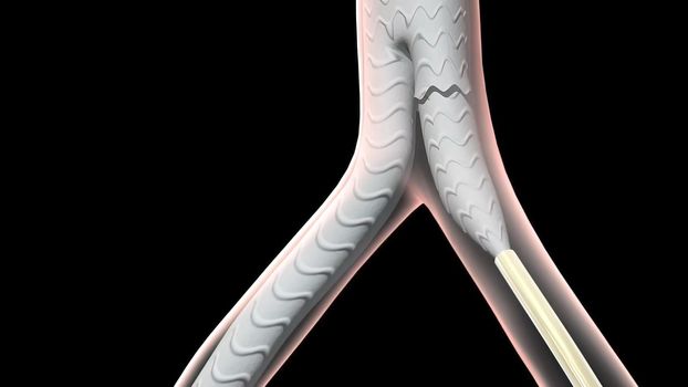 An abdominal aortic aneurysm occurs when a lower portion of the body's main artery (aorta) becomes weakened and bulges