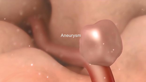 A brain aneurysm is a bulge or ballooning in a blood vessel in the brain. 3D illustration