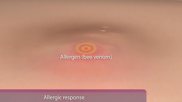Allergic reaction on human skin .