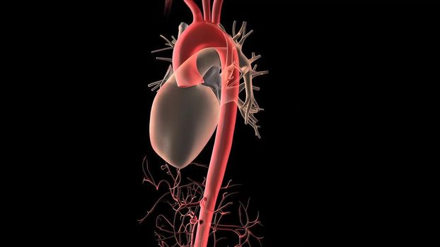 Aortic aneurysm and aortic dissection 3D Render