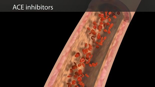 ACE inhibitors produce vasodilation by inhibiting the formation of angiotensin.