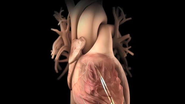 Arrhythmia The normal electrical activity of the heart is the result of the electrical activity of the area called the sinus node 3D Medical illustration