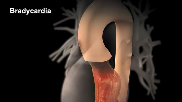 Bradycardia: This means a slow heartbeat - resting heart rate of less than 60 beats per minute 3D illustration