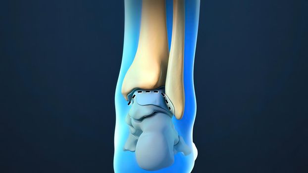 3D Render of Ankle Joint Anatomy and Osteoarthritis.The ankle is where the long tibia and fibula bones of the shin meet with the foot s talus bone.