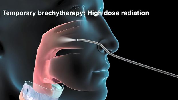 Damaged sick lungs. 3D render illustration for respiratory problems, cancer medical or health problems. Disease, respiratory problems, tumor and clinical case in the human body