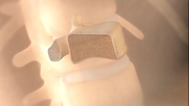 Bone damage in the spinal cord 3D illustration