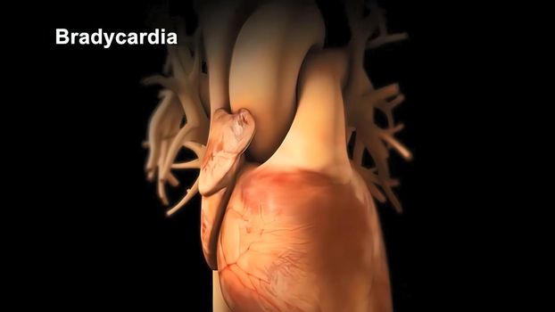 The bradycardia abnormally slow heart action 3D illustration