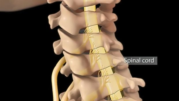 Anatomical view of the cervical spine with intervertebral disc-compressive nerve root prolapse. 3D illustration