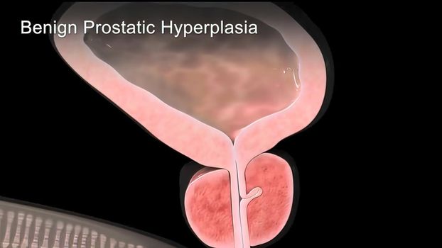 Benign Prostatic Hyperplasia 3d medical .