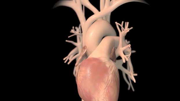 Coronary artery bypass surgery is done using a healthy blood vessel called a graft. 3D illustration