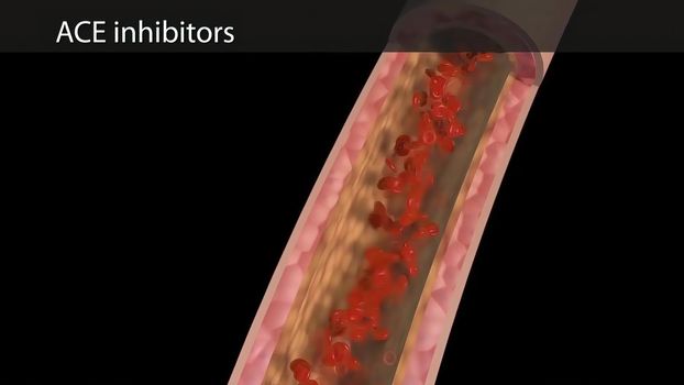 ACE inhibitors produce vasodilation by inhibiting the formation of angiotensin.