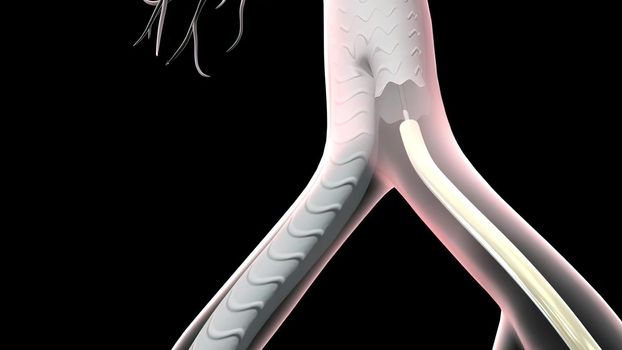 An abdominal aortic aneurysm occurs when a lower portion of the body's main artery (aorta) becomes weakened and bulges