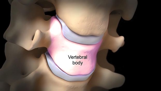 Pressure on nerves as a result of slipped disc 3D Render