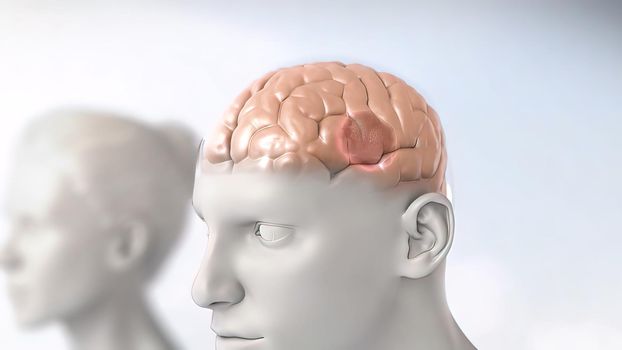 A brain tumor is a collection or mass of abnormal cells in your brain. 3D illustration