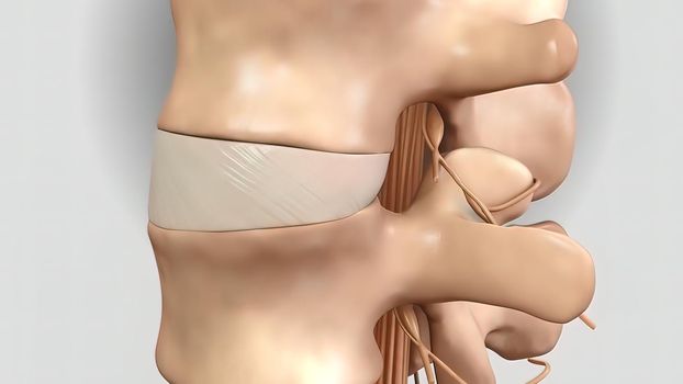 Pressure applied to the nerve as a result of the fracture of the spinal disc 3D illustration