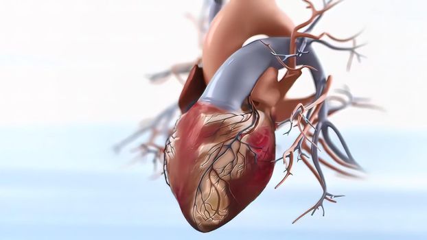 Acute Coronary Syndrome 3D illustration