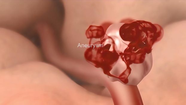 A brain aneurysm is a bulge or ballooning in a blood vessel in the brain. 3D illustration