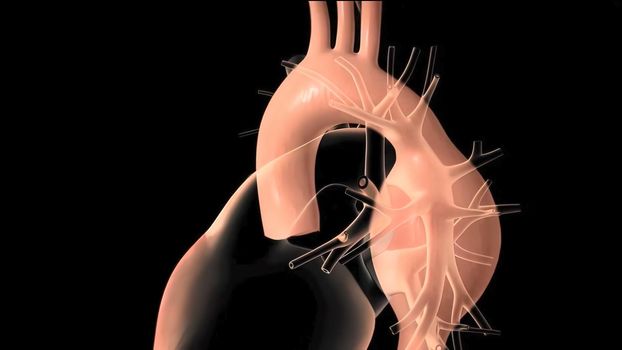 Hypoplastic left heart syndrome is a rare congenital heart defect in which the left side of the heart is severely underdeveloped.It may affect the left ventricle, aorta, aortic valve, or mitral valve. 3D Render