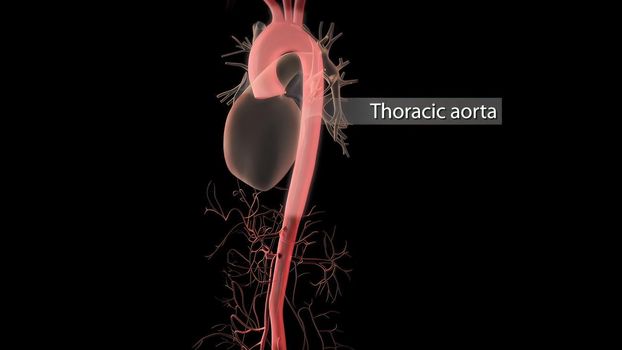 Aortic aneurysm and aortic dissection 3D Render