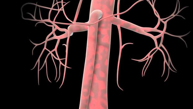 An abdominal aortic aneurysm occurs when a lower portion of the body's main artery (aorta) becomes weakened and bulges