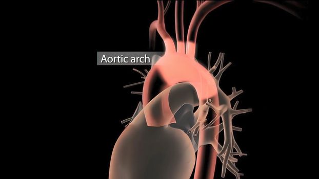 Hypoplastic left heart syndrome is a rare congenital heart defect in which the left side of the heart is severely underdeveloped.It may affect the left ventricle, aorta, aortic valve, or mitral valve. 3D Render