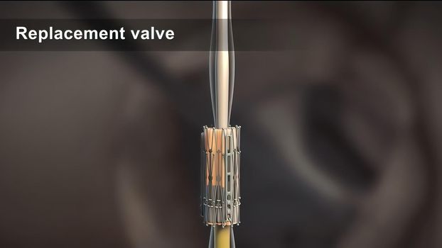 Cardiac catheterization is a procedure used to diagnose and treat certain cardiovascular conditions. 3D illustration