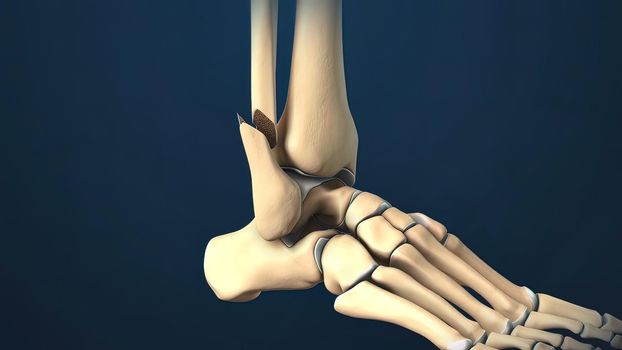 Foot and Ankle Fracture 3d medical illustration