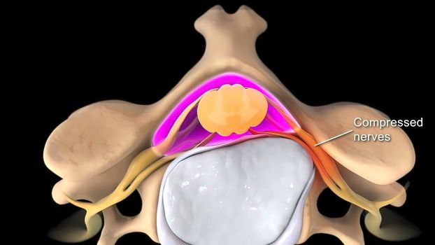 Breaking of the deformed disc and putting pressure on the nerve 3D illustration