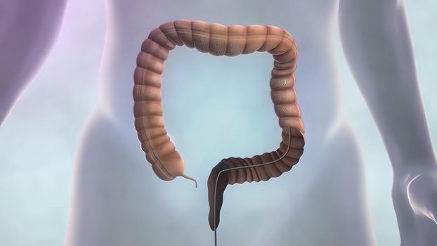 In this way, polyps, cancerous cells and abnormal structures in the large intestine can be diagnosed. The aim is to treat colon cancer, ulcerative colitis,3D illustration