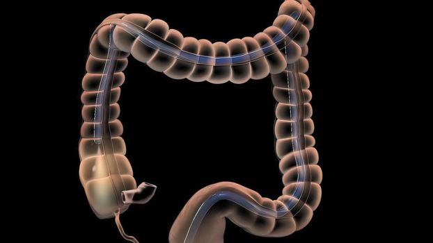 During a colonoscopy, a long, fleible tube (colonoscope) is inserted into the rectum. 3D illustration