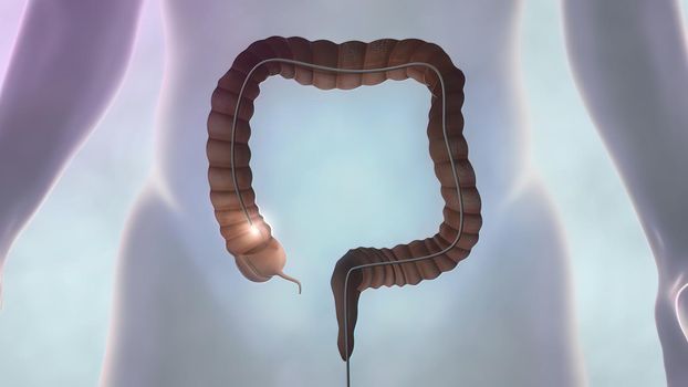 In this way, polyps, cancerous cells and abnormal structures in the large intestine can be diagnosed. The aim is to treat colon cancer, ulcerative colitis,3D illustration