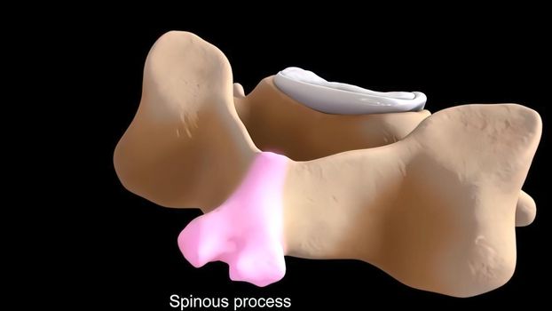 Pressure on nerves as a result of slipped disc 3D Render