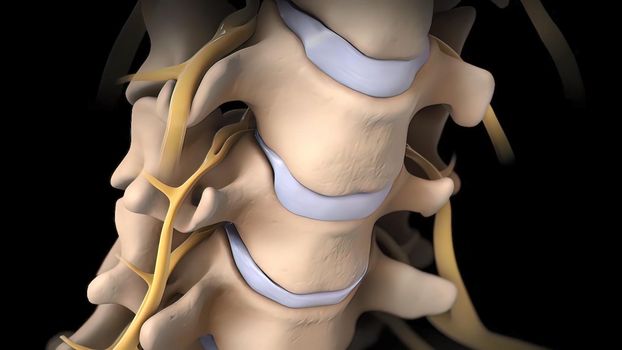 The intervertebral disc may become deformed and compress the nerve 3D illustration